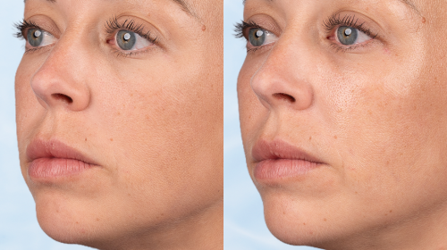 BABYGLOW™: IL NUOVO TRATTAMENTO FIRMATO TEOXANE